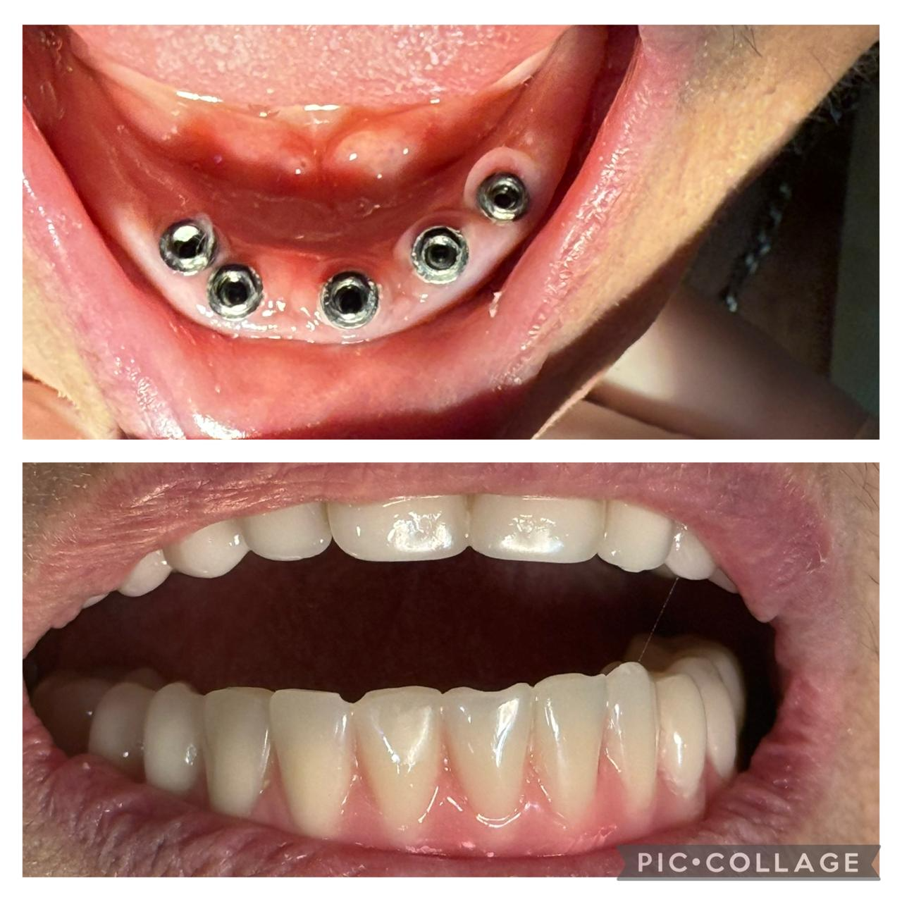 Registro clínico de implantes e prótese em duas imagens